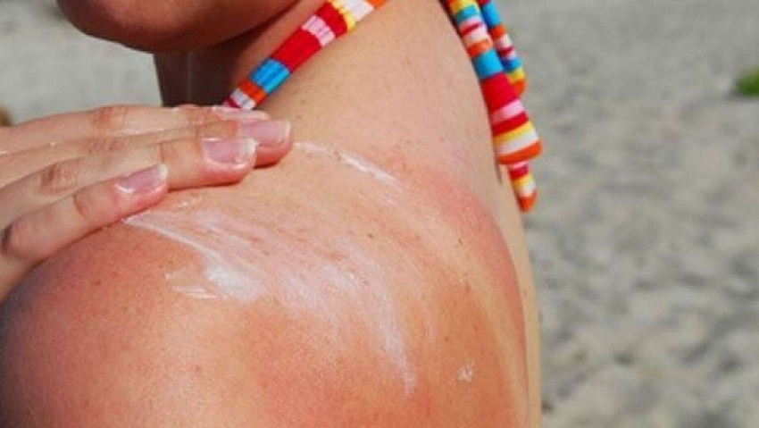 Làm gì khi da bị dị ứng kem chống nắng? Làm gì khi da bị dị ứng kem chống nắng?